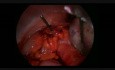 Laparoskopowa operacja skręcenia przydatków oraz usunięcie cysty jajnika oraz reoperacja z powodu martwicy