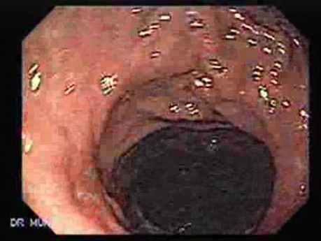 Żołądek klepsydrowaty - bliższe spojrzenie na wygojoną śluzówkę