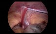 Operacja laparoskopowa przepukliny pachwinowej prawej u 3-letniej dziewczynki