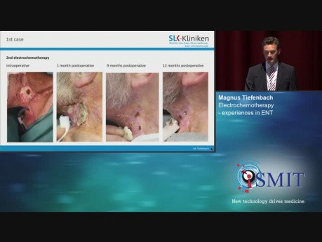 Elektrochemioterapia - odkrycia w otolaryngologii - SMIT 2019