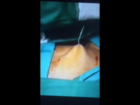 Metoda umieszczania trokarów laparoskopowych