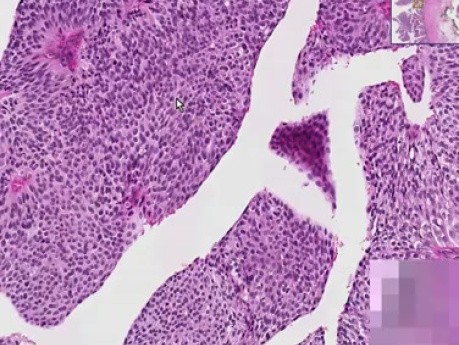 Rak komórek przejściowych  