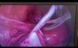 Laparoskopowa cystektomia lewego jajnika