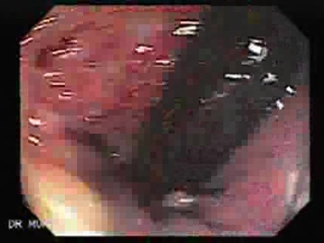 Gruczolaki cewkowo - kosmkowe odbytnicy - endoskopia (30 z 35)