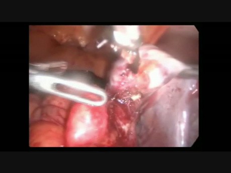 Ciąża pozamaciczna brzuszna- laparoskopia