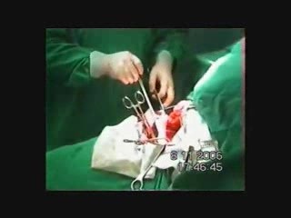 Operacja guza krwawiącego przełyku