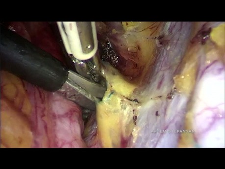 Radykalna histerektomia laparoskopowa typu B z izolacją guza szyjki macicy