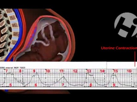 Cięcie cesarskie - blizna - anatomia i lokalizacja