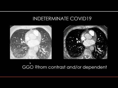 Obrazowanie klatki piersiowej u pacjentów z COVID-19.