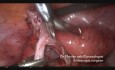 Trudne leczenie klasyczne 18 cm dermoidalnej torbieli jajnika