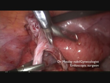 Trudne leczenie klasyczne 18 cm dermoidalnej torbieli jajnika