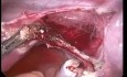 Laparoskopowe usunięcie 19-tygodniowej ciąży w niekomunikującym rogu szczątkowym macicy