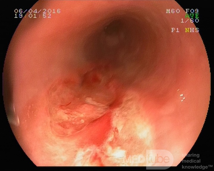 Owrzodzenia przełyku, przypadek (foto 3/4)