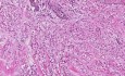 Rak zrazikowy - histopatologia - pierś
