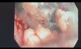Mukozektomia endoskopowa (EMR) polipa odbytnicy