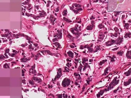 Rakowiak w oskrzelu - histopatologia - płuco