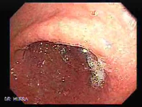 Gruczolakorak żołądka - wczesne stadium - endoskopia (5 z 5)