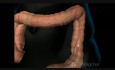 Colonoscopy