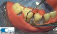 Krok po kroku: regeneracyjna chirurgia periodontologiczna z użyciem biologicznie aktywnego żelu oraz techniki zachowania brodawki dziąsłowej