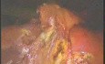 Cholecystektomia laparoskopowa - część 2