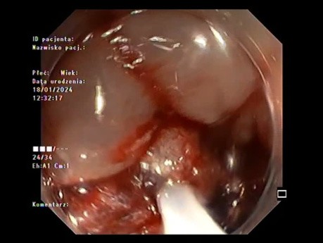 Duża zmiana o morfologii LST -G typu mieszanego leczona techniką mukozektomii (pEMR)