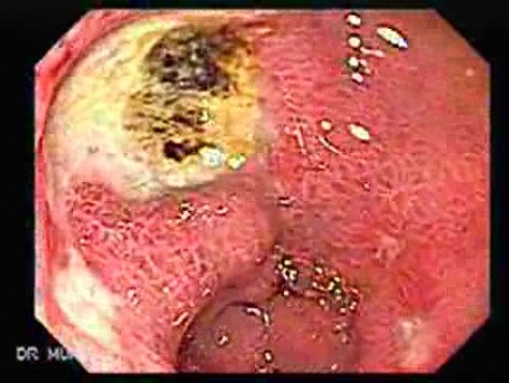 Mnogie wrzody żołądka - endoskopia (2 z 10)
