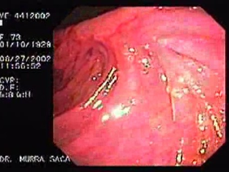 Gruczolakorak żołądka z komórkami sygnetowatymi - endoskopia (4 z 4)