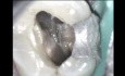Endodontyczna regeneracja kości