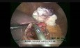 Laparoskopowy drenaż przez żołądek pseudotorbieli trzustki 