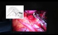Założenie staplera podczas wideotorakoskopowej lobektomii.