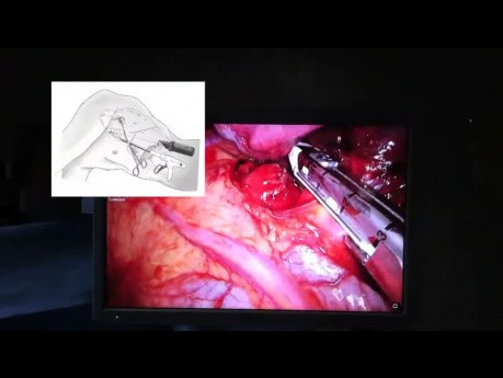 Założenie staplera podczas wideotorakoskopowej lobektomii.