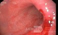 Endoskopia - przewlekła gastropatia w fazie aktywnej