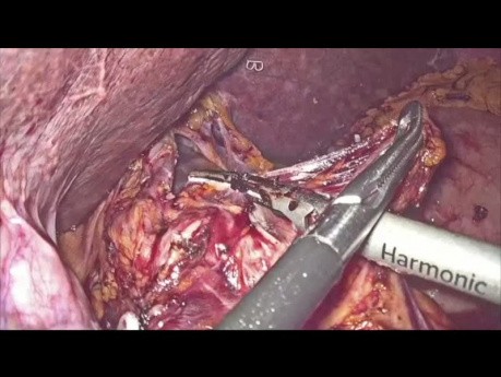 Gastrektomia laparoskopowa z powodu raka dystalnej części żołądka