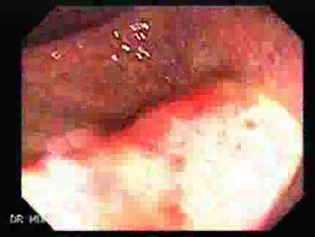 Wrzodziejące zapalenie jelita grubego typu pancolitis (5 z 7)