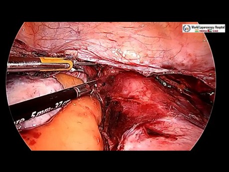 Całkowita laparoskopowa histerektomia- macica mięśniakowata