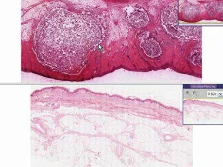 Czyrak - histopatologia - skóra