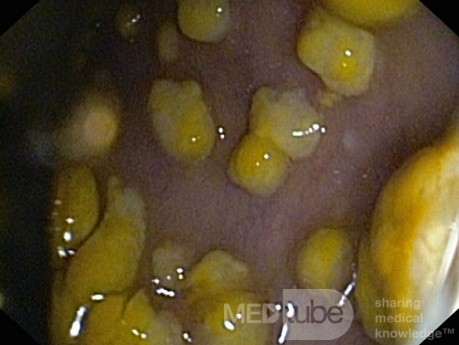 Rzekomobłoniaste zapalenie jelita grubego - obraz endoskopowy
