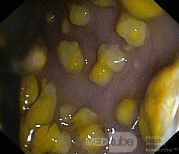 Rzekomobłoniaste zapalenie jelita grubego - obraz endoskopowy