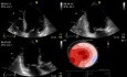 L'évaluation échocardiographique d'une insuffisance mitrale (IM)  - l'échocardiographie de stress sous dobutamine