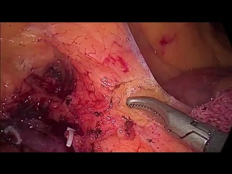 Hemikolektomia prawostronna metodą laparoskopową z powodu raka kątnicy, całkowite wycięcie krezki okrężnicy (CME)