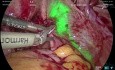 Laparoskopowa adenomiomektomia z wykorzystaniem obrazowania fluorescencyjnego