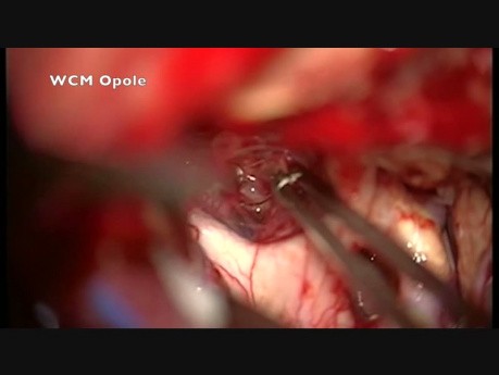 Craniopharyngeoma