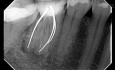 Usuwanie niedrożności w kanale korzeniowym – metalowe ćwieki oraz złamane narzędzie endodontyczne zlokalizowane w części wierzchołkowej