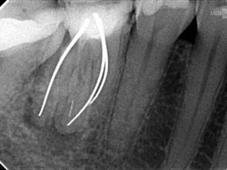 Usuwanie niedrożności w kanale korzeniowym – metalowe ćwieki oraz złamane narzędzie endodontyczne zlokalizowane w części wierzchołkowej