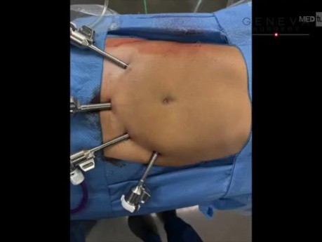 Robotyczna cholecystektomia z użyciem zieleni indocyjaninowej (ICG) i śródoperacyjnej cholangiografii (IOC); wariant anatomiczny przewodu wątrobowego tylnego prawego uchodzącego do przewodu pęcherzykowego
