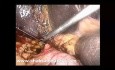Choledochoduodenostomia jako opcja leczenia chirurgicznego nawracających kamieni przewodu żółciowego wspólnego