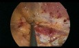 Laparoskopowa trójstopniowa neurektomia w leczeniu przewlekłego bólu po naprawie przepukliny pachwinowej