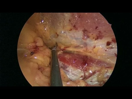 Laparoskopowa trójstopniowa neurektomia w leczeniu przewlekłego bólu po naprawie przepukliny pachwinowej