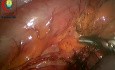 Laparoskopowa sigmoidektomia z powodu skrętu esicy