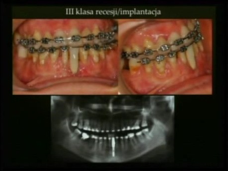 Skojarzone leczenie orto-perio-implantologiczne. Doświadczenia własne - część 5